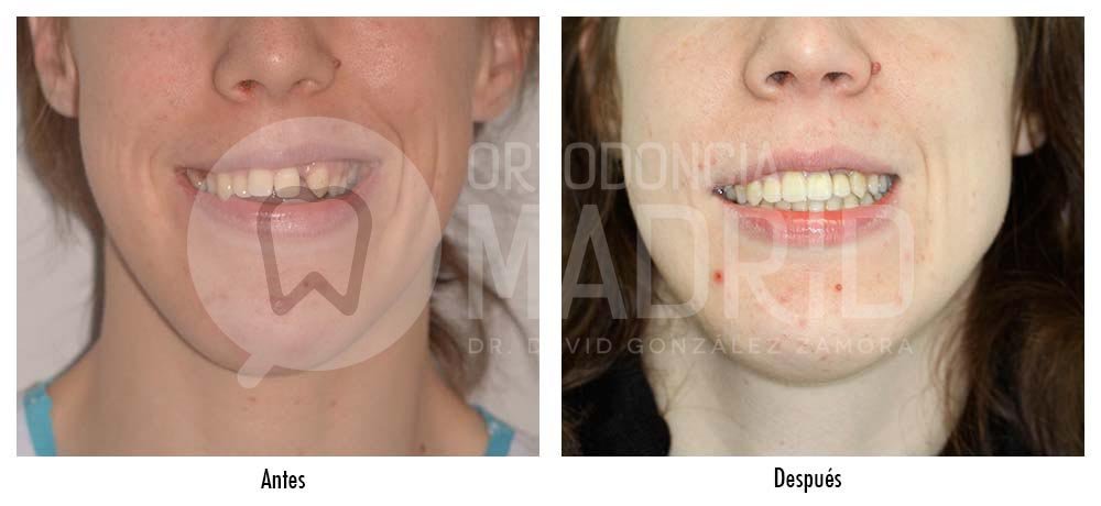 Ortodoncia Madrid - Cirugía ortognatica e implantes