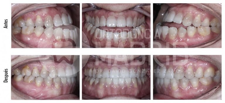 ortodoncia-madrid-clase-iii-esqueletica-dentaria-moridida-abierta-cruzada-140-w1-1170x538