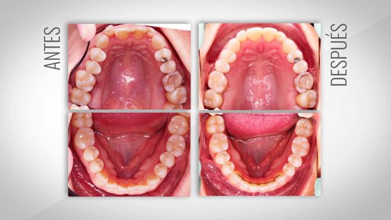 mordida-abierta-ortodoncia-madrid