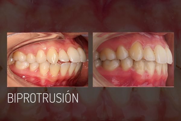 biprotrusion