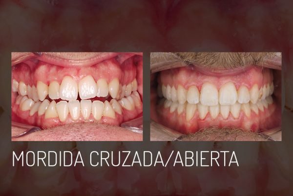 mordida-cruzada-abierta
