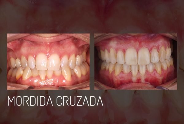 mordida-cruzada