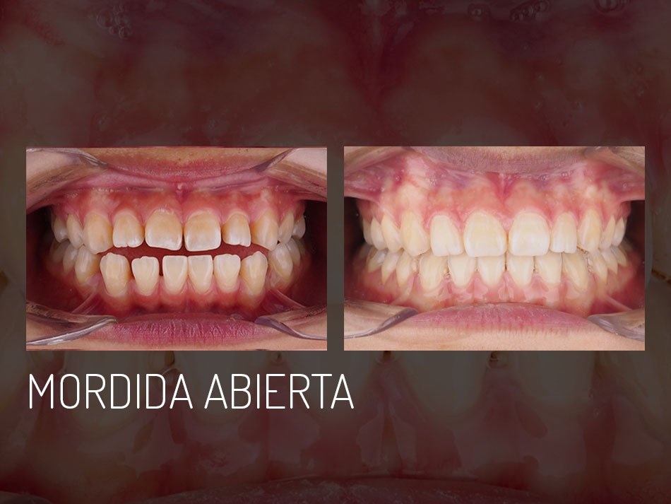 mordida-abierta