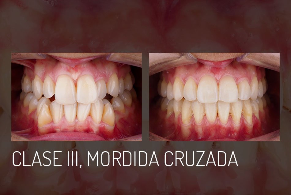 clase-III-mordida-cruzada