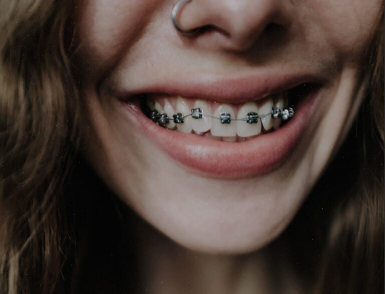 brackets-ortodoncia
