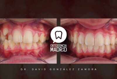 mordida cruzada anterior