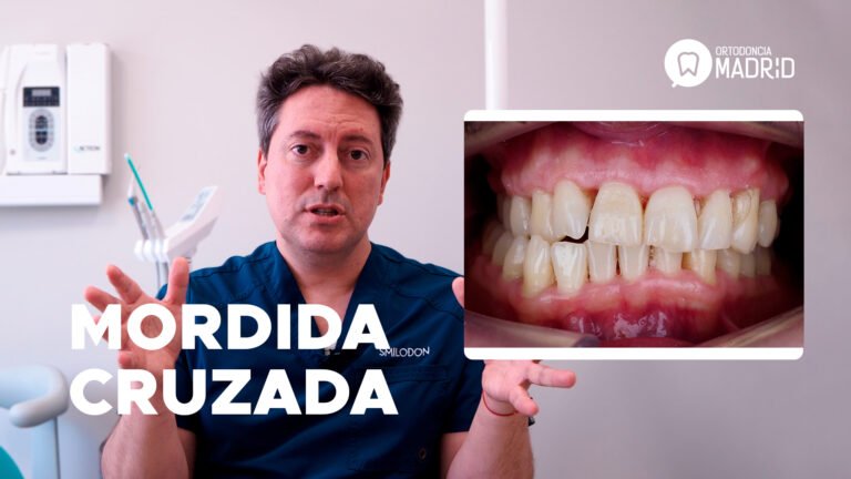 mordida-cruzada
