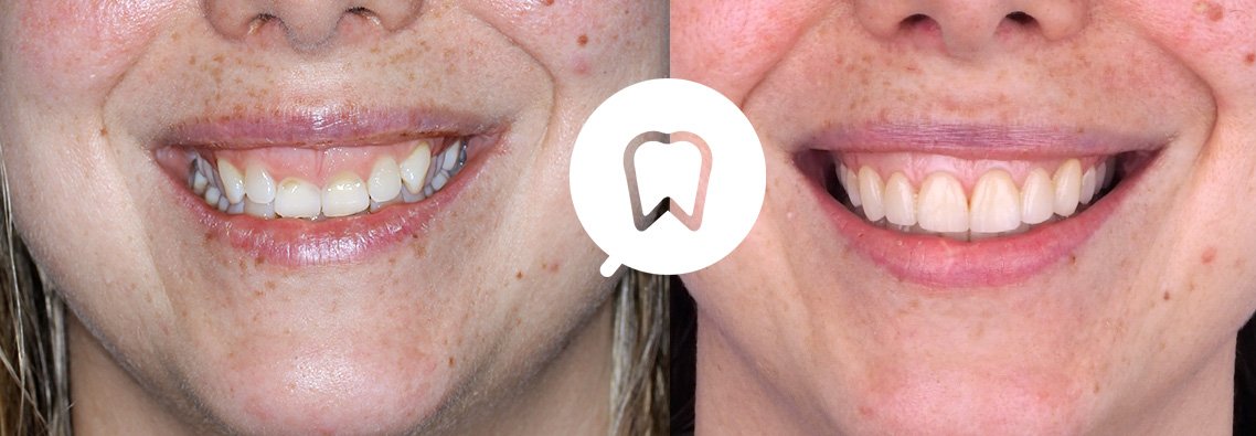 sonrisa-gingival-caso