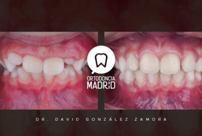 clase-II_avance-mandibular