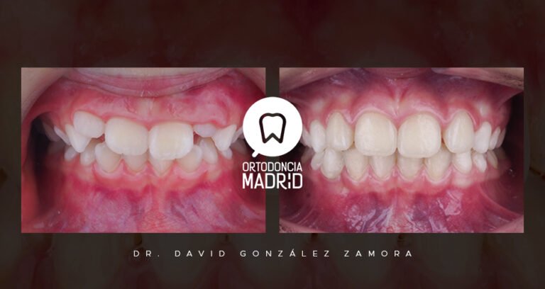 clase-II_avance-mandibular