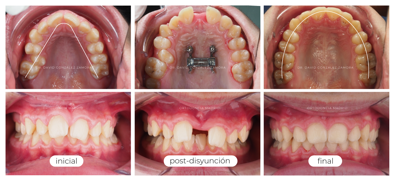 disyuncion-marpe-madrid