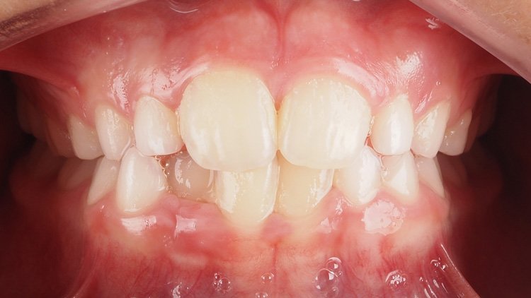 apiñamiento-dental