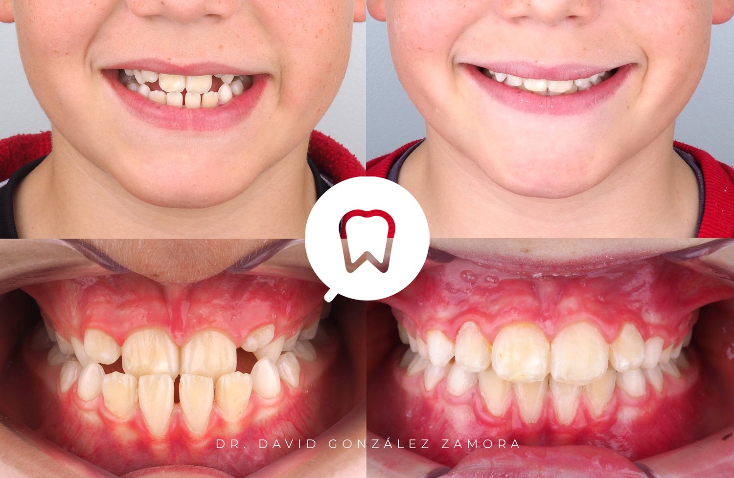 ortodoncia-infantil-madrid