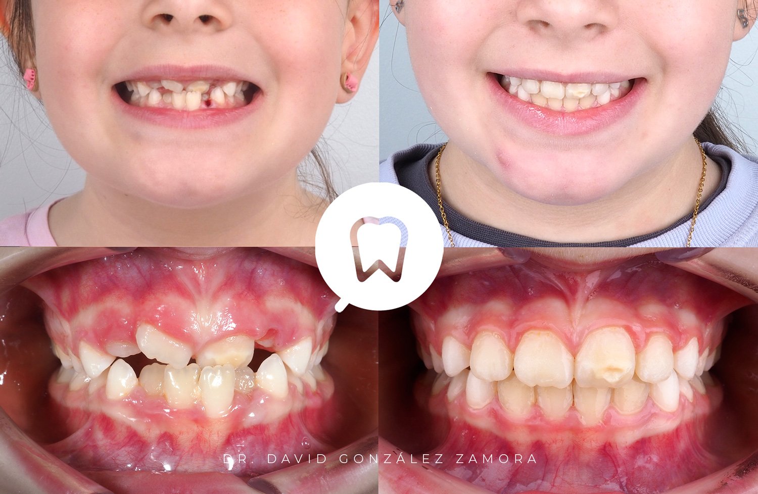 ortodoncia-infantil-madrid