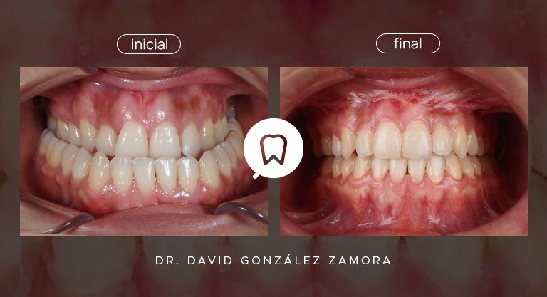 Clase III esquelética y dentaria con mordida cruzada completa tratada con alineadores y cirugía ortognática en Ortodoncia Madrid.