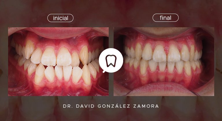 caso clínico de ortodoncia con brackets y ortognática para el tratamiento de una clase III esquelética y mordida cruzada