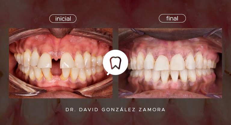 Caso clínico de diastema y biprotusión tratado con brackets de autoligado en Ortodoncia Madrid.