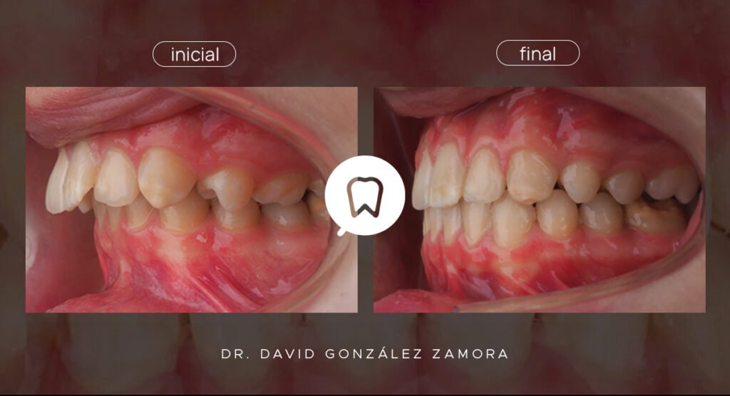 Antes y después de un caso de clase II tratado con alineadores y avance mandibular, con reducción del resalte y la sobremordida